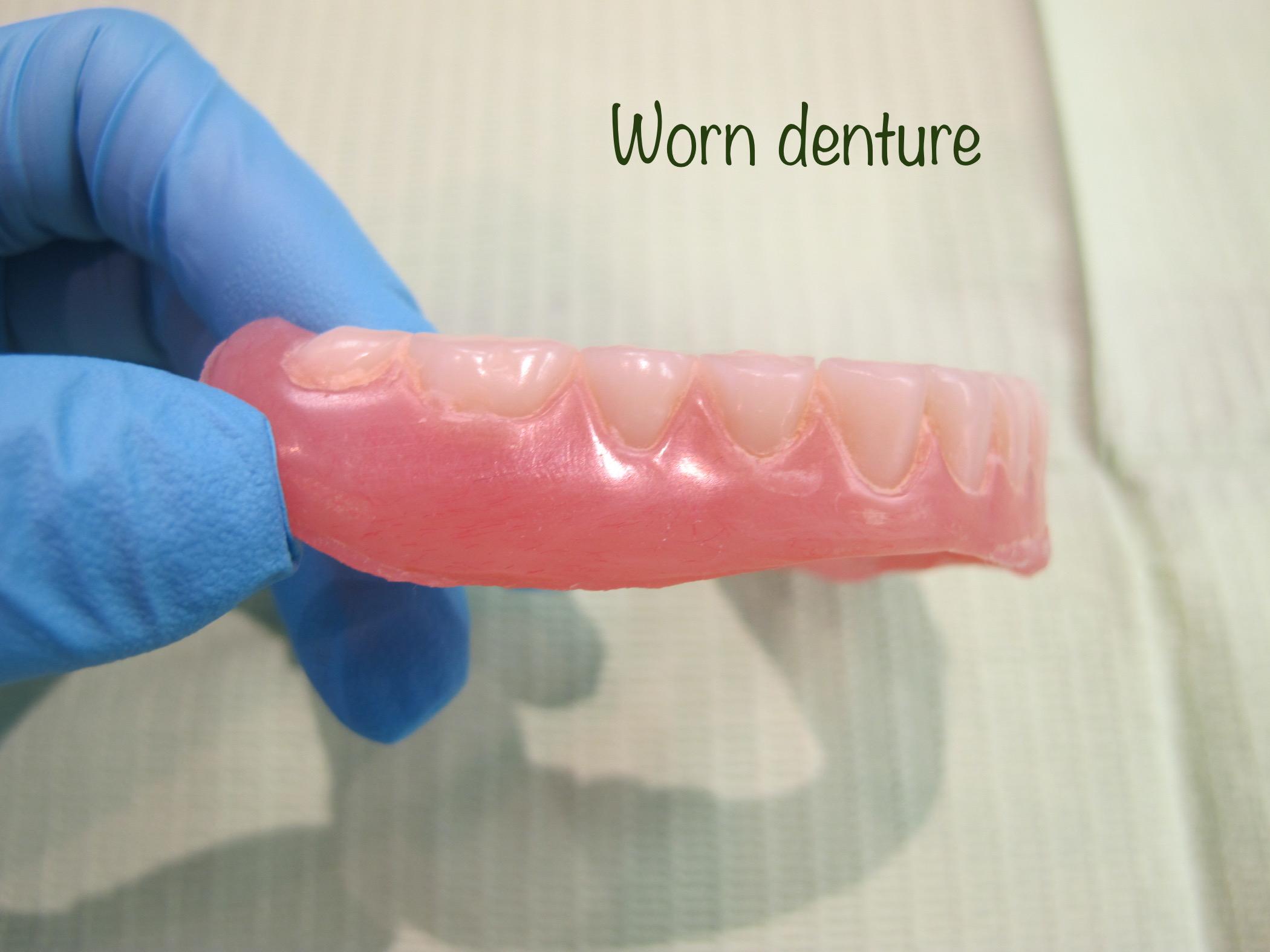 What Causes Dentures to Wear Down Over Time 2